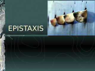 Epistaxis-2002-04-slides.ppt
